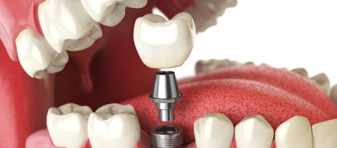 Tooth human implant. Dental concept. Human teeth or dentures. 3d illustration